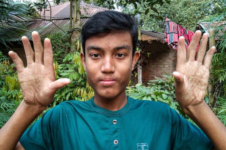 Без отпечатков: Бангладешская семья испытывает трудности из-за отсутствия отпечатков пальцев