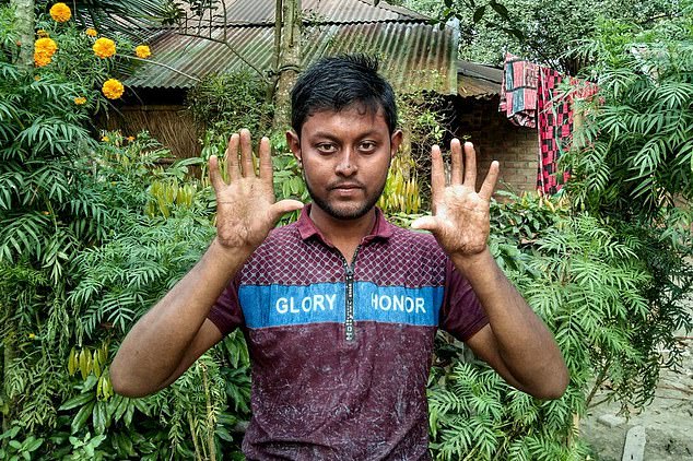 Без отпечатков: Бангладешская семья испытывает трудности из-за отсутствия отпечатков пальцев