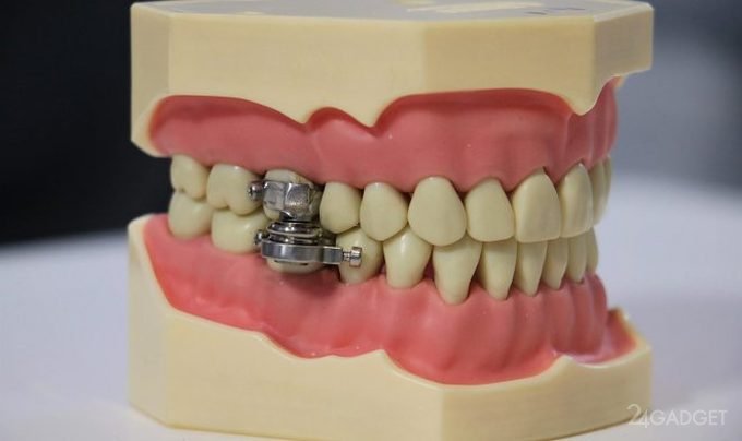 60407 Электромагнитный замок внутри рта обеспечит эффективное похудение (2 видео)